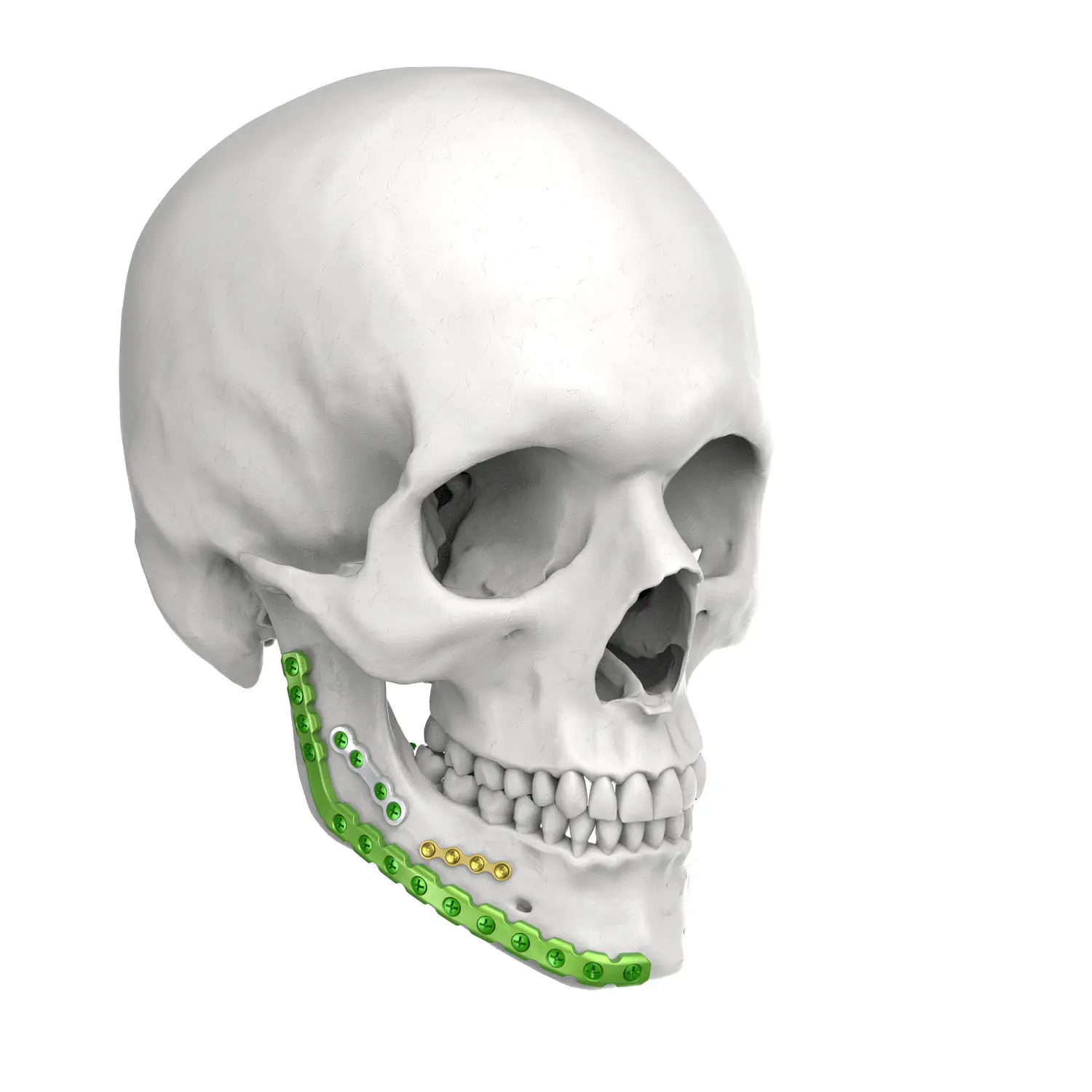 下颚加压接骨板- Jeil Medical Corporation - 锁定/ 金属