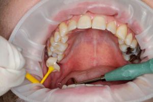 開口器　万能開口器 脸颊牵开器- OptraGate - Ivoclar Vivadent/义获嘉伟瓦登特