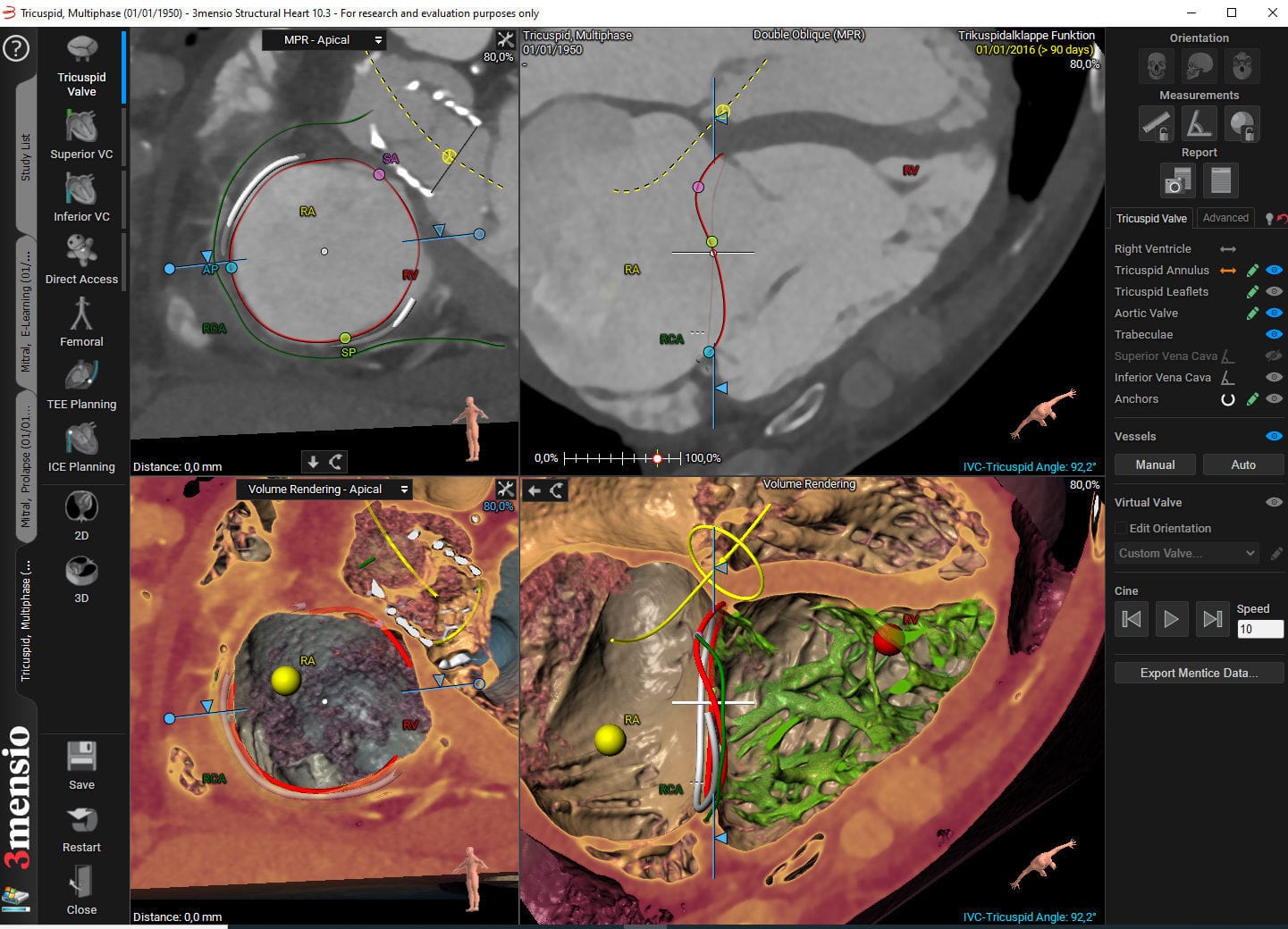 医用软件 3mensio Tricuspid Valve Pie Medical Imaging 报告 / 图像分析 / Windows