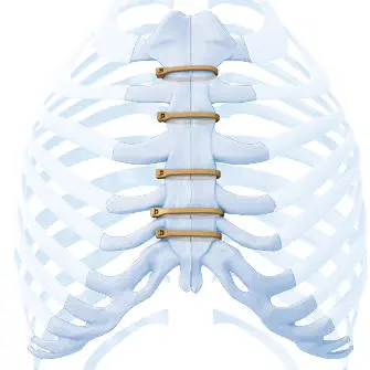 胸骨加压接骨板 Zipfix Depuy Synthes 德普 金属