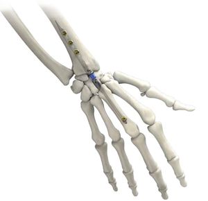 手腕髓内钉