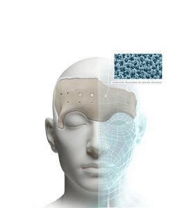 3D打印整形假体
