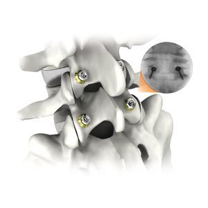 胸腰椎脊柱内固定系统 1