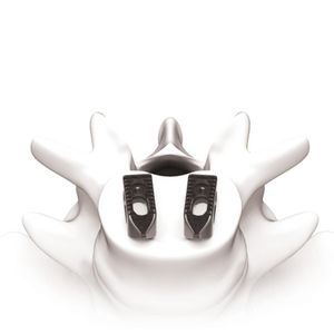 胸腰椎间融合器 1