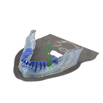 牙科植入模拟软件 - Reconstruction 3D - Drive Dental Implants - 3D 可视化 / 模型制作 / 口腔移植手术