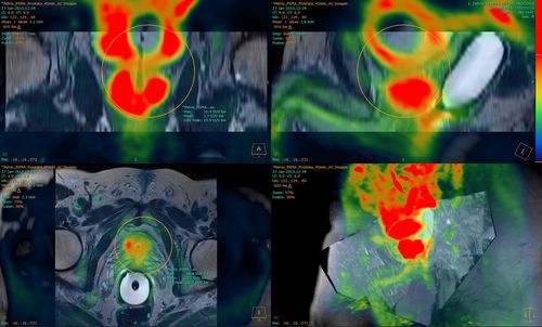 分析软件 - Fusion Technology™ - Hermes Medical Solutions, Inc - 3D 可视化 / 报告 / 带跟踪系统