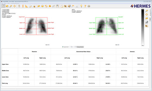 分析软件 - Lung Lobe Quantification™ - Hermes Medical Solutions, Inc - 诊断 / 规划 / 评估