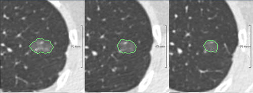 医学诊断软件 - Veolity™ - MeVis Medical Solutions AG - CAD / 筛查 / 肺癌筛查