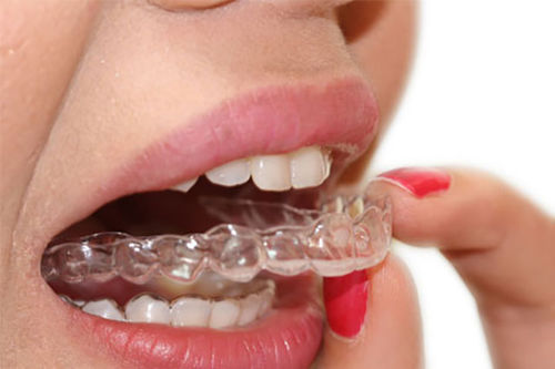 牙科矫正器 - Smilers  - BIOTECH DENTAL