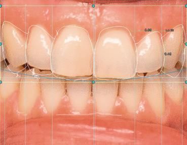 设计软件模块 - 4218 - Champions Implants GmbH - 加工 / CAD / 规划