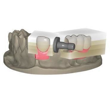 牙齿修复软件模块 - In-Cad Nesting - Champions Implants GmbH - 设计 / 生产 / 牙齿