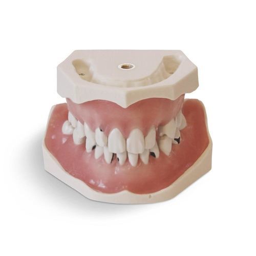牙齿解剖模型 - E06 - GF DENTAL - 牙龈 / 用于牙周 / 培训