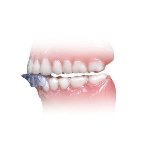 磨牙症口腔固定托 - NTI-tss Plus® - Glidewell Europe