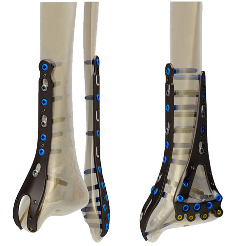 腓骨加压接骨板 -  STEP® - Response Ortho - 胫骨 / 远侧 / 未锁定