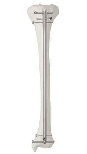 胫骨髓内钉 - Da Vinci™ - AOS - Advanced Orthopaedic Solutions - 近端固定 / 远端固定