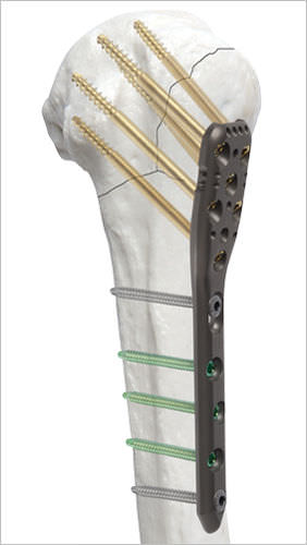 肱骨加压接骨板 - AOS - Advanced Orthopaedic Solutions - 近端 / 锁定 / 金属