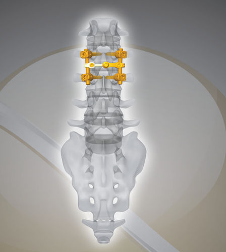 腰椎脊柱内固定系统 - NEX D2 - Next Orthosurgical - 后入路
