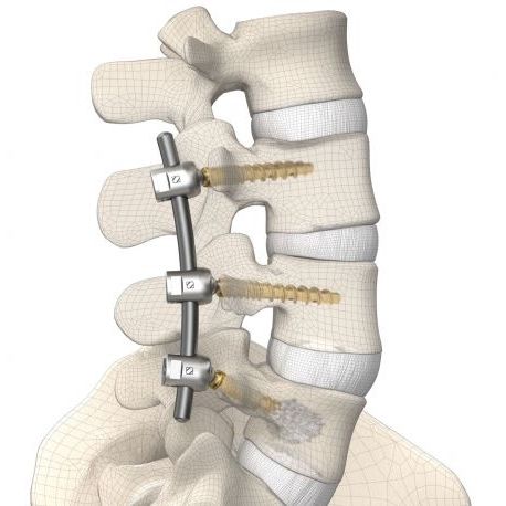 胸腰椎脊柱内固定系统 - DIPLOMAT®  - Signus Medical - 后入路