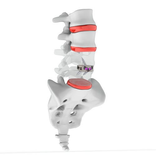 腰椎间融合器 - ANTENOR STAND ALONE ALIF CAGE - Osimplant - 前入路 / 钛
