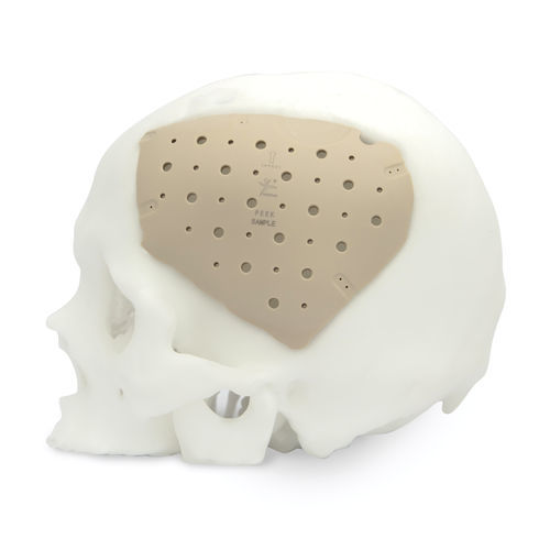 定制颅内植入物 - CranioPEEK3D ™ - Kontour Medical Technology