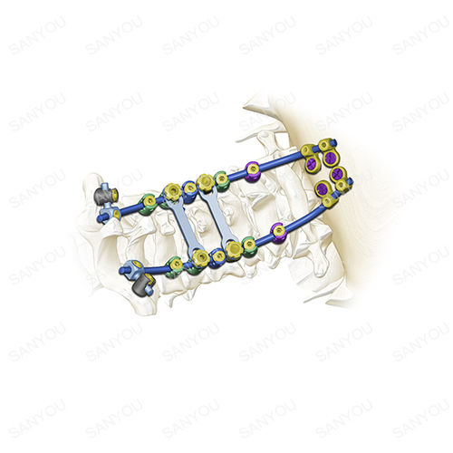 枕颈脊柱内固定系统 - Cervina® - Shanghai Sanyou Medical - 后入路