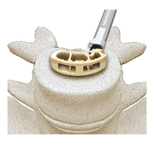 腰椎间融合器 - Dica - Shanghai Sanyou Medical - 后入路 / PEEK材质