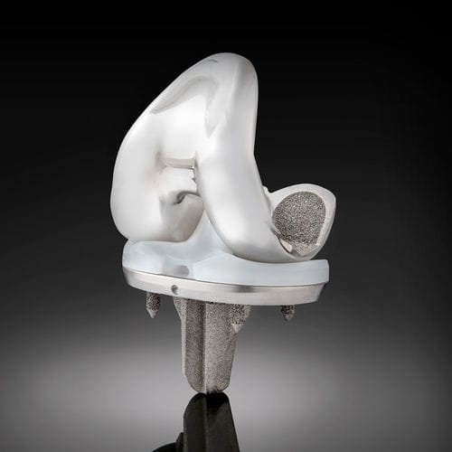 三间隔膝关节假体 - Truliant® Porous  - Exactech - 活动轴承 / 非骨水泥