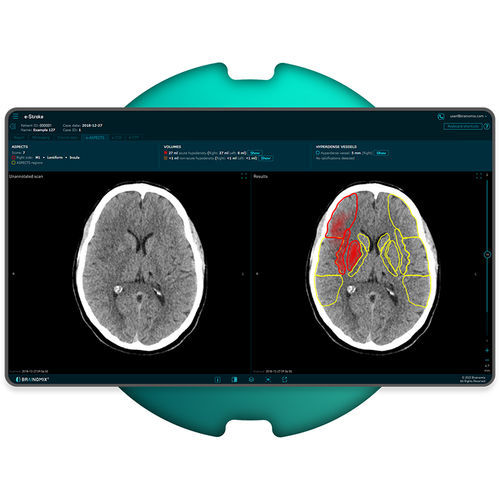 中风诊断软件 - e-Stroke - Brainomix - 医用 / CT计算机断层扫描 / 图像分析