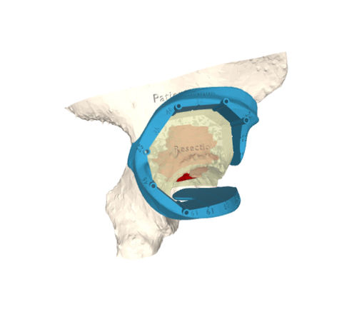 人工髋关节假体截骨导向器 - 3D Side