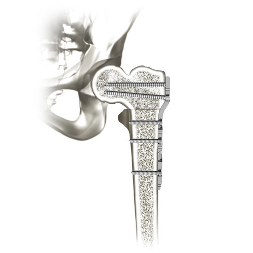 股骨加压接骨板 - 00-0907-0103 - OrthoPediatrics - 近端 / 锁定 / 金属