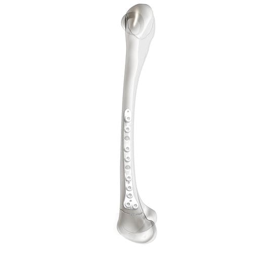 股骨加压接骨板 - PediLoc® - OrthoPediatrics - 远侧 / 侧面 / 锁定
