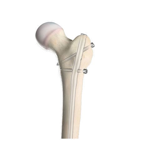 股骨髓内钉 - 00-1501-0720 - OrthoPediatrics - 近端固定 / 远端固定 / 儿科