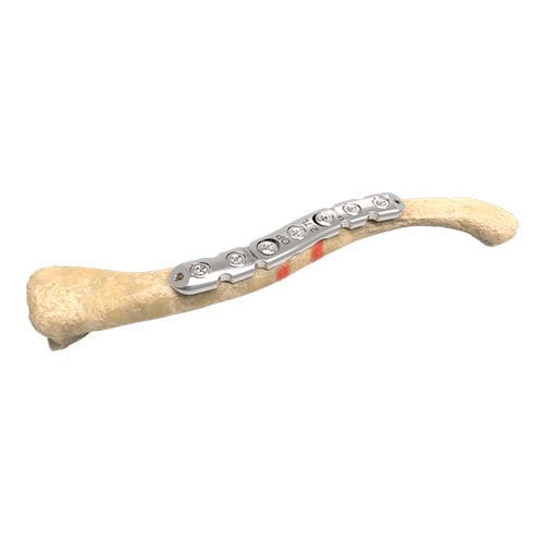 锁骨加压接骨板 - 00-1005-5006 - OrthoPediatrics - 中间 / 锁定 / 金属