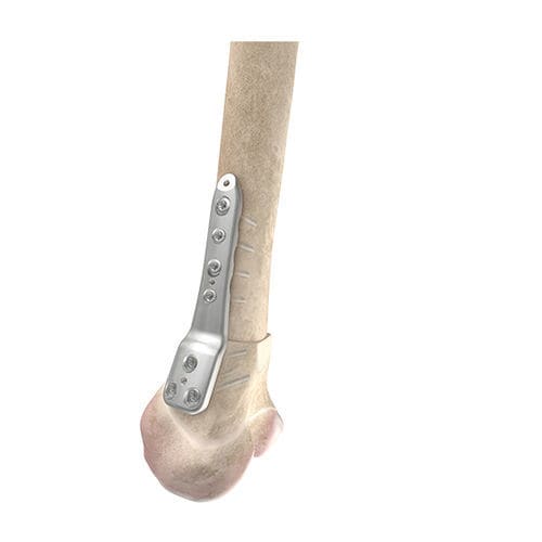 股骨截骨术固定板 - 00-1050-5104 - OrthoPediatrics - 远侧 / 锁定 / 金属