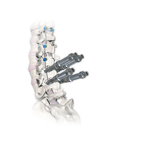 胸腰椎脊柱内固定系统 - RESPONSE™ 4.5/5.0 - OrthoPediatrics - 后入路 / 儿科