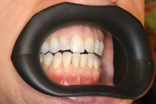嘴唇牵开器 - VisionButler™ - Gate Dental Services Ltd - 脸颊 / 牙科 / 加压加热