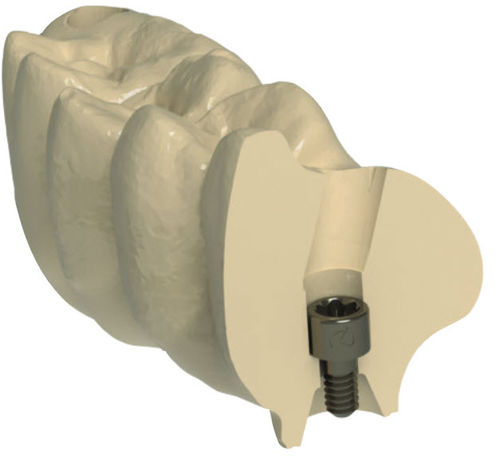 牙齿修复牙科材料 - G-DAS - Dynamic Abutment Solutions - CAD/CAM / 铣削 / 高透明