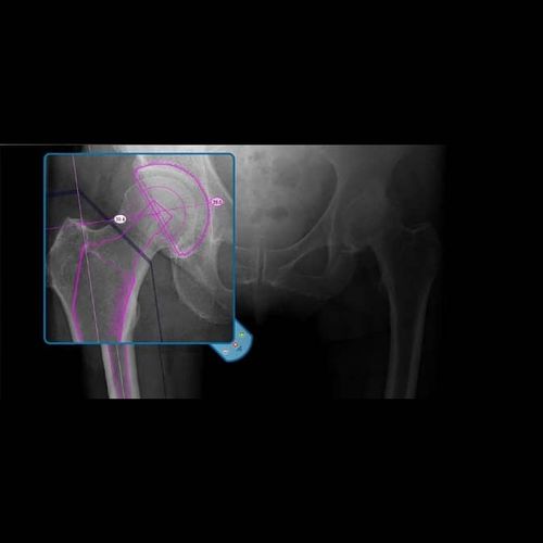 医用软件 - OrthoView - Materialise UK - 分析 / 管理 / 规划