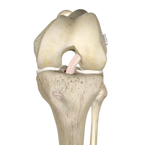 前十字韧带人工韧带anchorman