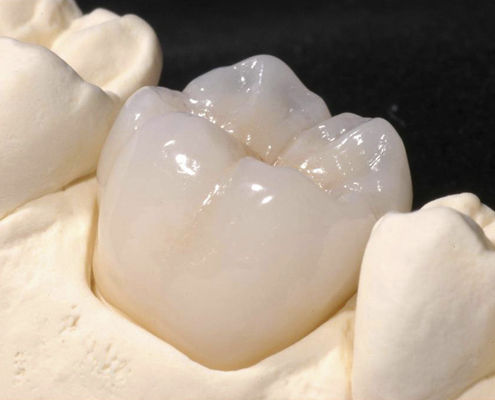 氧化锆牙冠 - CRYSTAL - Derby Dental - 后牙 / 后牙