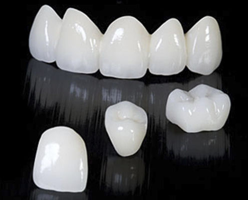 氧化锆牙桥 - CRYSTAL - Derby Dental - 后牙