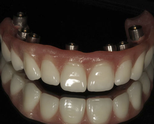 丙烯塑料假牙 - Screw Retained  - Derby Dental - 后牙 / 后牙