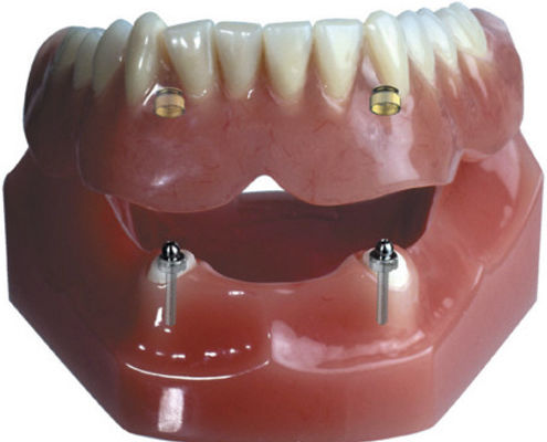 后牙假牙 - Attachment Retained  - Derby Dental - 后牙