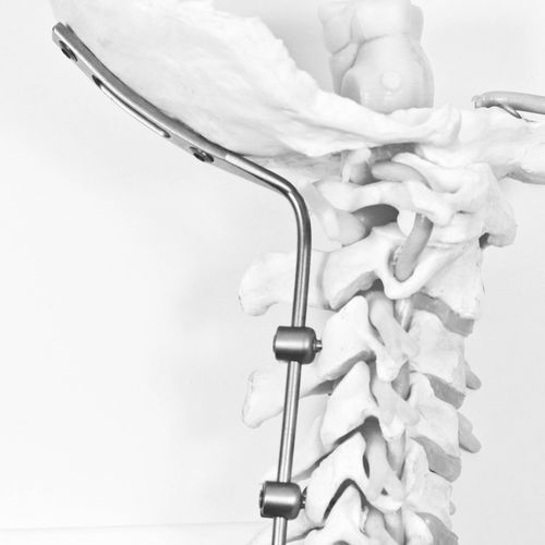 枕颈脊柱内固定系统 - J.O.C. - NEURO FRANCE Implants - 后入路