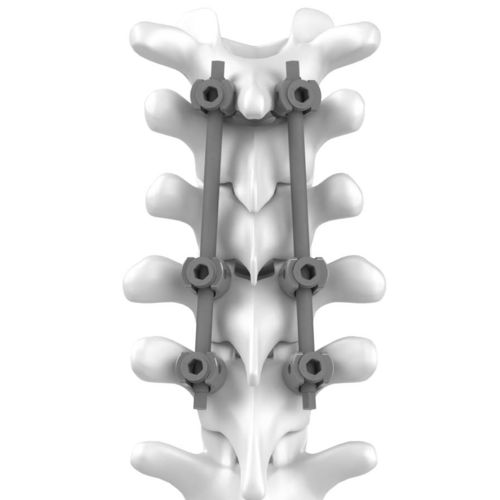 颈胸廓脊柱内固定系统 - C.T.J - NEURO FRANCE Implants - 后入路