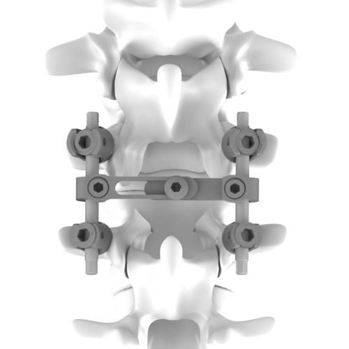 胸腰椎脊柱内固定系统 - K.M. - NEURO FRANCE Implants - 后入路