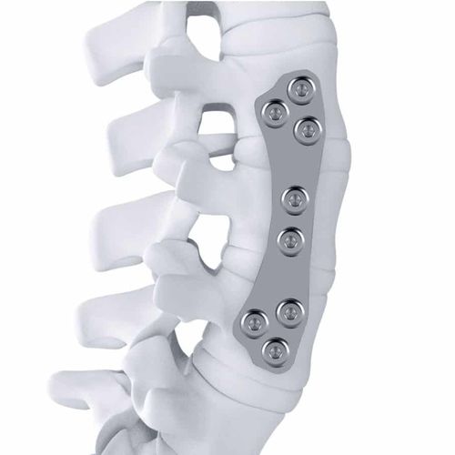 腰椎关节固定板 - ARTHEMIS - NEURO FRANCE Implants - 胸腰椎 / 前外侧 / 钛