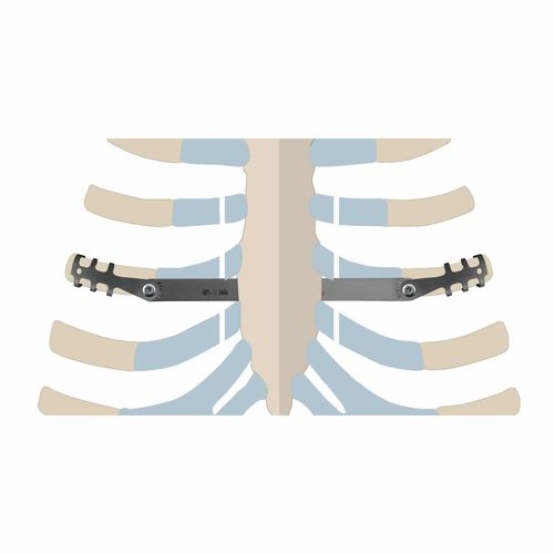 肋骨加压接骨板 - ThoRib® PECTUS - NEURO FRANCE Implants - 钛 / 儿科