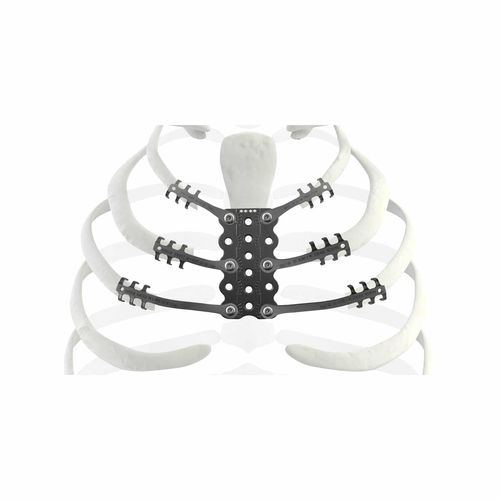 骨肉瘤切除重建人工肋骨 - TRIONYX® - NEURO FRANCE Implants