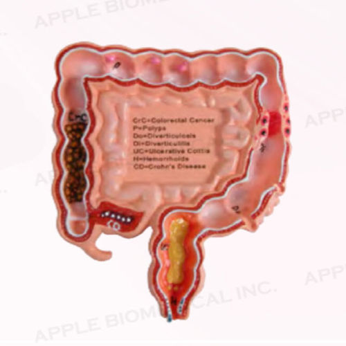 结肠解剖模型 - A345 - Apple Biomedical - 肠胃科 / 教学 / 粉色